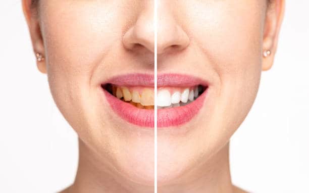 Teeth Whitening Milton Keynes Nottinghamshire