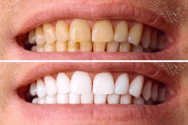 Laser White For Ever Bright – Get a Brighter, Whiter Smile with LA Teeth Whitening Nottinghamshire