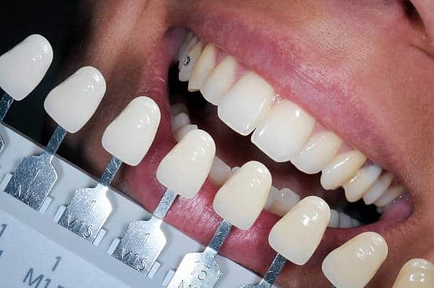 Get Natural and Stunning Smile with Teeth Whitening Results from LA Teeth Whitening Nottinghamshire