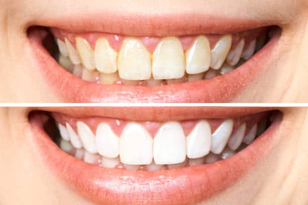 Achieve a Dazzling Smile for Your Special Day: A Guide to Wedding Teeth Whitening Nottinghamshire