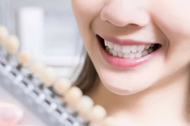 Teeth Whitening Kings Norton Nottinghamshire